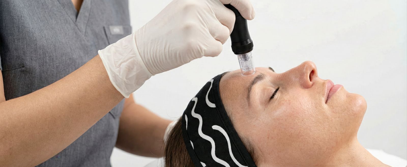 MICRONEEDLING TREATMENT